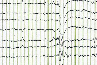 epilepsy20130923051900191.jpg